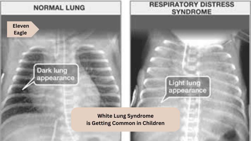 White Lung Syndromes: What is the white lung syndrome? symptoms and remedies